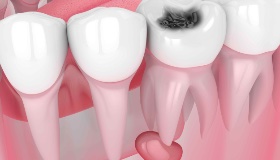Лечение периодонтита зубов